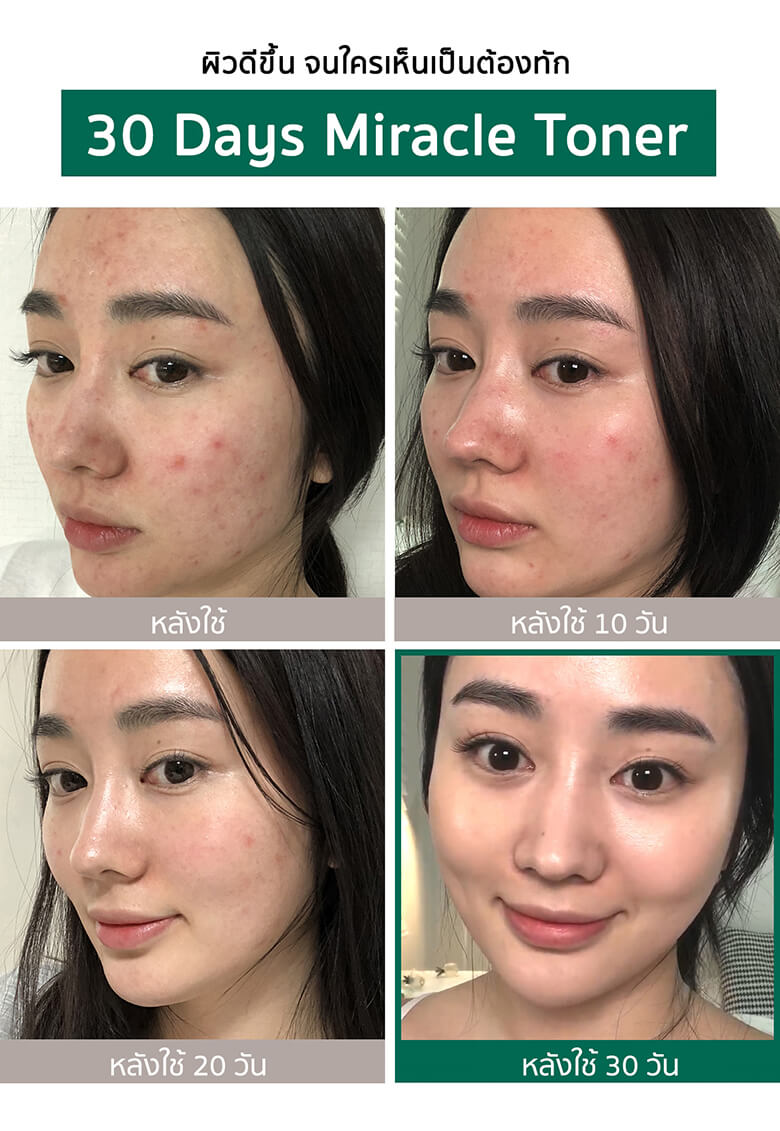 some by mi รีวิว,some by mi serum รีวิว,some by mi toner รีวิว,some by mi miracle toner ราคา,some by mi miracle toner รีวิว,some by mi miracle serum รีวิว,some by mi miracle toner review,some by mi โทนเนอร์